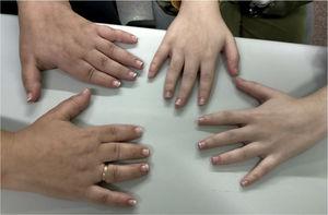 Comparison of hands between case 2 (mother) and case 3 (daughter). In the mother (left), we observe brachydactyly and clinodactyly, while in the daughter (right), they are present to a lesser extent.