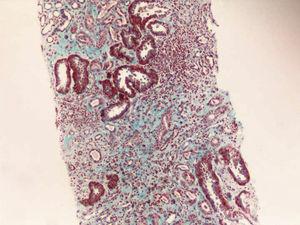 Masson's trichrome staining ×100: interstitium with abundant fibrosis, tubular atrophy, acute tubular damage with regeneration and chronic inflammatory infiltrate.