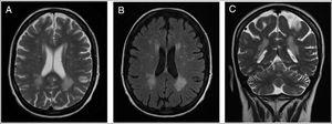 Axial T2 (A), Axial T2 FLAIR (B), Coronal T2 (C) – demonstrating disseminated punctuated and confluent WML on the periventricular and subcortical areas (patient 2).