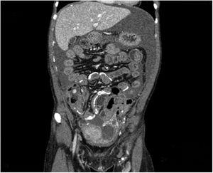 Peritoneal calcifications can be seen in a coronal CT image of the patient in April 2018.