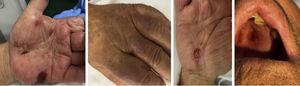 Lesions on the skin and mucous membranes after the administration of iodinated contrast.