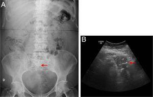 A) Radiografía simple de abdomen en decúbito supino, luminograma intestinal normal con una imagen radioopaca e inespecífica, proyectada sobre el hueso sacro. B) Ecografía abdominal, muestra una masa heterogénea en hipogastrio.