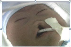 Mongoloid obliquity of palpebral fissures, nasal hypoplasia, cleft palate and cleft lip.
