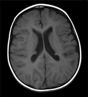 T1-weighted sequence in brain magnetic resonance image, showing subependymal nodules.
