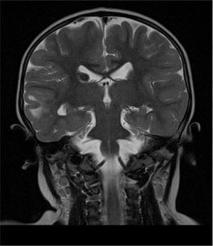 T2-weighted sequence in brain magnetic resonance image, showing subependymal nodules.