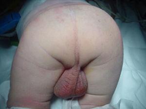 Image of patient anorectal malformation.