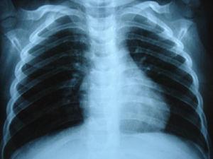 Postoperative thoracic X-ray.
