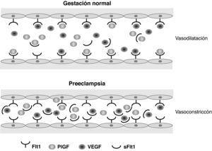 Esquema representativo del equilibrio normal entre factores angiogénicos circulantes, comparado con la disfunción endotelial inducida en la preeclampsia. Flt1: fms-like tyrosine kinase 1; PlGF: placental growth factor; sFlt1: soluble fms-like tyrosine kinase; VEGF: vascular endothelial growth factor.