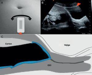 Trayecto desde el orificio cervical interno al corion. A y B) movimiento de la sonda ecográfica identificando trayecto. C) en azul se dibuja el espacio entre la membrana corial y la decidua materna.