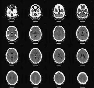 Magnetic resonance image in which the presence of slight, predominantly frontal cerebral atrophy is notable.