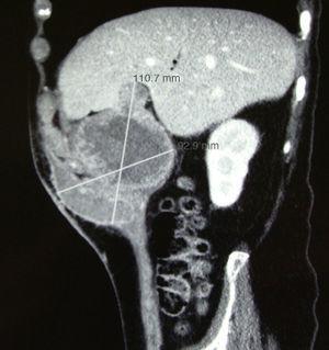 Abdominal computed tomography, sagittal slice.