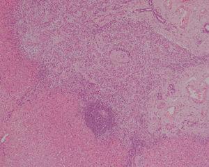 Compact nodular proliferation of the bile ducts, with peripheral inflammatory infiltrate (4×, haematoxylin–eosin).