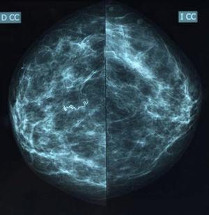 Bilateral mammogram, craniocaudal projections: a linear, serpiginous calcification is observed in the right breast.