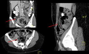 Coronal, transversal and sagittal CT scans with arrows showing images of the tubular structure compatible with omental torsion.