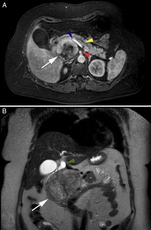 (A) Axial magnetic resonance image showing retroperitoneal location of the lesion (white arrow), superior mesenteric artery (arrowhead), splenic–mesenteric–portal axis (arrowhead), dilated Wirsung duct (arrowhead); (B) Coronal magnetic resonance image with gadolinium showing heterogeneous characteristics of the lesion (white arrow) and the dilated bile duct (arrowhead).