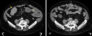 Axial tomography of the abdomen showing the intussusception causing the intestinal obstruction (left, arrow) and the presence of other tumor implants (left, asterisk). Right photo, follow-up 12 months after surgery where the disappearance of the intestinal metastatic melanoma lesions is observed.