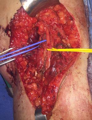 Image of the right popliteal region after lymphadenectomy (dark gray: popliteal nerve; light gray: popliteal vein).