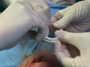 Placement of the Alexis® retractor device in the surgical field, rolling it over the plastic membrane.