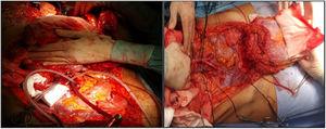 Cannulation of the external iliac arteries (it is not necessary to cannulate the veins) and preparation of the graft for extraction.