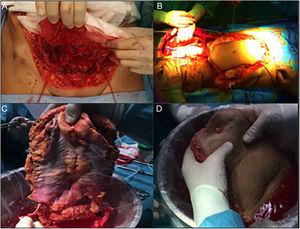 Phases of complete graft extraction: (A) Dissection of the inferior epigastric vessels; (B) Preparation of cannulae with the flap “at home”; (C) Bench dissection of the inferior epigastric vascular arcade; (D) Confirmation of perfusion.