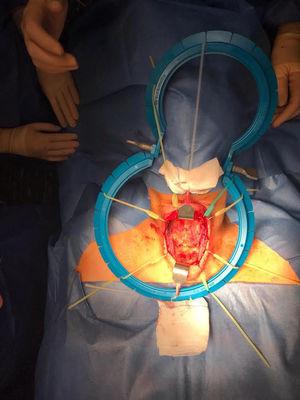 Exposure of the left hemithyroid using the Lone Star® device during hemithyroidectomy.