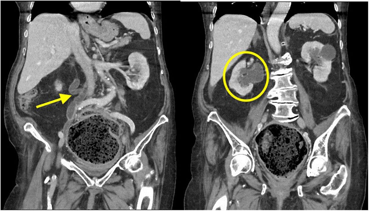 Fecal impaction, Radiology Reference Article