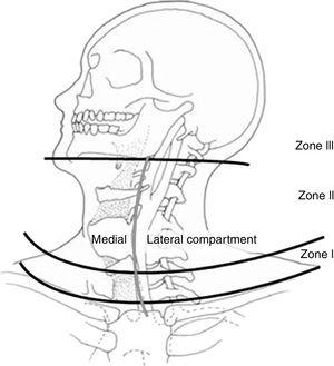 Anatomical zones of the neck (Source: Monson et al.69).