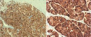 Immunohistochemistry: neuroendocrine carcinoma of the breast. Intense and diffuse staining of cell membranes and cytoplasm is observed for both synaptophysin (left, 100×) and for chromogranin (right, 200×).