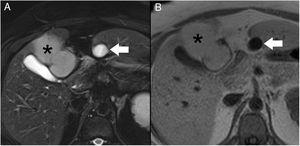 MRI scan of the liver. Axial sequences T2 BLADE with fat saturation (A) and T1 Flash (B). The subhepatic collection (arrow) shows notable hyperintensity on T2 and hypointensity on T1, indicating liquid content. A teratoma of the liver is observed (asterisk).