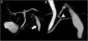 Magnetic resonance cholangiopancreatography. T2 TSE, volumetric reconstruction (A): the normal gallbladder is observed in its characteristic location (asterisk). Magnified view (B): the subhepatic collection shows an appearance similar to a gallbladder, located anterior to the pancreas (arrow); at the cranial end, a duct is observed that is joined to the main pancreatic duct at the junction of its distal two-thirds (arrowhead).