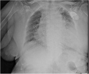 Urgent thoracic radiograph showing congestive pulmonary hilum, a small left pulmonary effusion and important cardiomegaly.