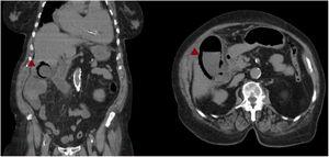 Coronal and transversal thoracoabdominal scans with evidence of emphysematous cholecystitis, rarefaction of the adjacent fat, and significant wall emphysema.