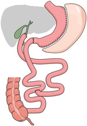 Image of the duodenal switch technique.