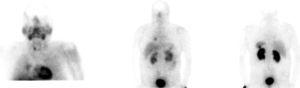 Somatostatin receptor scintigraphy. Planar images of the head, chest, and abdomen at 4 and 24h. Planar images show two nodular lesions with a high density of somatostatin receptors in the right hemithorax and in front of the inferior plane of the spleen.