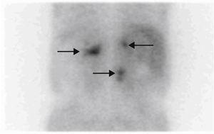 MIBG scintigraphy: uptake by both adrenal glands and retroperitoneal mass.