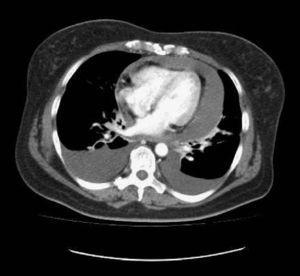 CT scan of the chest revealing pleuropericardial effusion.