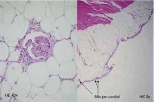Pericardial metastases of papillary thyroid carcinoma.