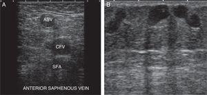 (A) The anterior saphenous veins occupies one anterior position with respect to deep veins. (B) Tertiary network in the subcutaneous cellular tissue. SFA: superficial femoral artery; ASV: anterior saphenous vein; CFV: common femoral vein.