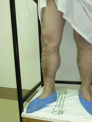 Varicose veins and trophic changes in preoperative exploration.