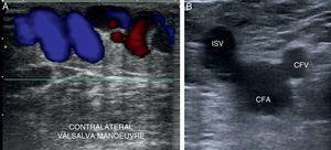 (A) Reflux with color Doppler (Valsalva maneuver). (B) Mickey Mouse sign. CFA: common femoral artery; CFV: common femoral vein; ISV: internal saphenous vein.