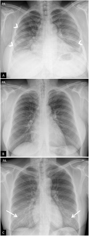 False positives or pitfalls. (A and B) Chest X-ray with poor inspiration. A 38-year-old woman with signs and symptoms raising suspicion of COVID-19. (A) Posteroanterior chest X-ray. Bilateral increase in density, predominantly in the middle and lower fields, raising suspicion of COVID-19 pneumonia (arrow tips). Poor inspiration (7 posterior costal arches are identified) and voluminous breasts. (B) Same patient. Repeat chest X-ray a few minutes after forced inspiration, wherein all above-mentioned findings are no longer seen (note the change in the morphology of the cardiac silhouette). (C) Artefact due to high breast density. An 18-year-old woman with signs and symptoms raising suspicion of COVID-19. Bilateral symmetrical opacities in lower fields due to highly dense breast tissue (arrows). Negative PCR results for SARS-CoV-2.