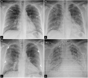 Typical findings in COVID-19 pneumonia. (A) A 47-year-old woman with signs and symptoms raising suspicion of COVID-19. Posteroanterior (PA) chest X-ray. Reticular interstitial pattern with peripheral predominance (arrows). (B) Same patient as in image A. PA chest X-ray taken 3 days later. Positive PCR for SARS-CoV-2. Despite being taken with poorer inspiration, the X-ray shows faint rounded bilateral peripheral alveolar opacities (dotted arrows). (C) A 57-year-old male with dyspnoea and positive PCR for SARS-CoV-2. Bilateral peripheral opacities in upper, middle and lower fields (arrow tips). (D) A 45-year-old male with dyspnoea and COVID-19 confirmed by PCR. Anteroposterior chest X-ray showing multiple bilateral diffuse confluent areas of consolidation with extensive involvement of both lungs. Note the presence of two central venous lines, one left jugular and the other right subclavian (white arrows), and a gastrointestinal tube (black arrow).