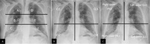 Methods for grading severity of pulmonary involvement secondary to COVID-19 by chest X-ray. (A) Grading method suggested by Borghesi et al.33,34 Using an upper horizontal line (lower edge of the aortic arch) and a lower horizontal line (lower edge of the right inferior pulmonary vein), 6 lung fields are obtained. Each field is assigned a score based on radiological findings: 0 if there are no findings; 1 if there are interstitial infiltrates; 2 if there are interstitial and alveolar infiltrates with an interstitial predominance; and 3 if there are interstitial and alveolar infiltrates with an alveolar predominance. The maximum score is 18. According to this grading system, in the case presented, the score would be: A = 2, B = 3, C = 3, D = 3, E = 3 and F = 3. Total score = 17/18. (B) Adaptation of the “Radiographic Assessment of Lung Edema” (RALE) method proposed by Warren et al.35, initially devised to grade the severity of acute pulmonary oedema. Using a vertical line (along the spine) and a horizontal line (along the lower edge of the left main bronchus), 4 quadrants are obtained. Each quadrant is assigned a score of 0–4 depending on the extent of consolidation or ground-glass opacities (0 = no findings; 1 < 25%; 2 = 25%–50%; 3 = 50%–75%; 4 > 75%). These scores must be multiplied by another score assigned to consolidation density (1 = incipient, 2 = moderate, 3 = dense). The maximum score is 48. According to this grading method, the example presented would be scored as follows: Q1 = 2 × 1 = 2; Q2 = 4 × 3 = 12; Q3 = 2 × 3 = 6, and Q4 = 2 × 3 = 6. Total score = 26/48. (C) Grading method used by Schalekamp et al.78. This divides the thorax into 4 quadrants. Each quadrant is assigned a score of 0–2, where 0 = no involvement; 1 = medium/moderate involvement (0–50% of the lung parenchyma); and 2 = severe impairment (>50% of the parenchyma). Maximum score of 8. This example would be scored as follows: right upper quadrant = 1; right lower quadrant = 2; left upper quadrant = 1; left lower quadrant = 1. Total score = 5/8. This study found that scores averaging 4.4 ± 1.9 and bilateral involvement were associated with critical illness.