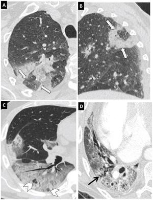 Typical findings in COVID-19 pneumonia on computed tomography (CT). Images from a CT scan of the chest with 1-mm slices. (A and B) Axial (A) and sagittal (B) images showing a lesion in the posterior segment of the right upper lobe with the reversed-halo sign (arrows). (C) Extensive ground-glass involvement with areas of consolidation in the right lower lobe with the vacuolar sign (arrow tips). (D) Abnormal architecture of the right lower lobe with a crazy-paving pattern and bronchial dilation (black arrow).