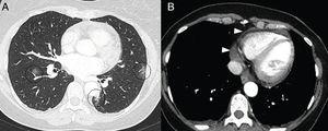 A 50-year-old woman with signs and symptoms of fever and retrosternal pain with a pericardial rub on auscultation. A CT scan showed ground-glass opacities (A) in relation to mild COVID-19 involvement (circles) and mild pericardial effusion (arrow tips in B).