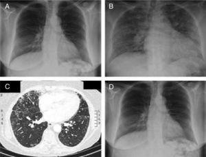 (A) Chest radiography prior to admission shows no acute pulmonary disease. (B) Chest radiography performed hours after the third transfusion shows bilateral pulmonary alveolar infiltrates. (C) Computed tomography angiography of the pulmonary arteries confirms the existence of bilateral and diffuse alveolar infiltrates. (D) Chest radiography 72h after the onset of clinical symptoms shows a complete disappearance of bilateral pulmonary infiltrates.
