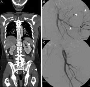 A 54-year-old male with multiple trauma secondary to automobile accident. Preserved vital signs. (A) WBCT in portal phase; coronal MPR showing splenic laceration with small perisplenic hematoma and pseudoaneurysm (arrow). Complex left pelvic fracture with active bleeding foci (arrow head). (B) Angiography confirmed the multiple active bleeding foci (arrow heads). (C) Bleeding points resolved by embolization, in the same way as the splenic pseudoaneurysm (not shown).