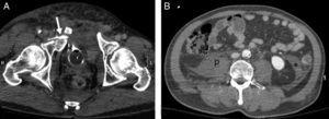A 40-year-old male. Motorcycle accident. (A) WBCT, axial plane of the pelvis showing complex pelvic ring fracture with intravesical (Foley catheter) contrast leakage into soft tissues (arrow). (B) Axial plane of the abdomen showing absence of hemoperitoneum. Retroperitoneal hematoma occupying right psoas muscle (p) and retromesenteric fascia (*).