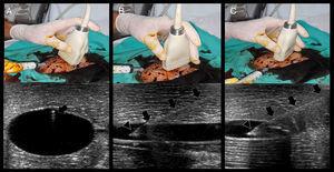 Real-time US-guided vascular cannulation. (A) Short axis (out of plane) technique. Arrows: needle and its reverberation artifact; (B) long axis (in plane) technique. Arrows: needle body, Arrowhead: needle bevel; (C) oblique (in plane) technique. Arrows: needle body; arrowhead: needle bevel.