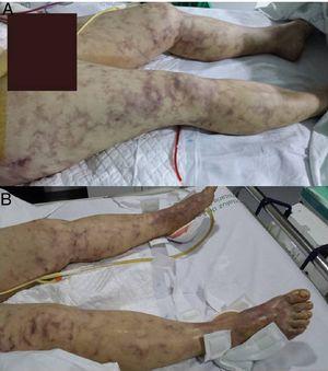 Image of livedo reticularis on the lower extremities, first 24h of admission. Skin involvement comprising the upper abdomen, hips, buttocks and both feet, with “blue toes”. The image at top shows drainage after emergency laparotomy with splenectomy, gastrectomy and pancreatectomy due to multivisceral infarcts.